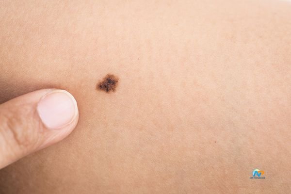 Are Birthmarks a Sign of Luck or Risk What Skin Experts Reveal
